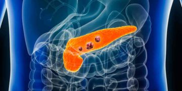 Annuncio di Burioni sul tumore al pancreas