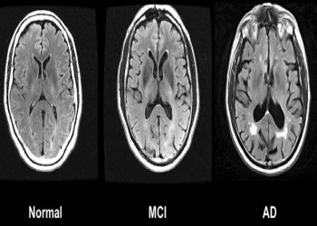 Il cervello di una persona che soffre di Alzheimer messo a confronto con uno normale