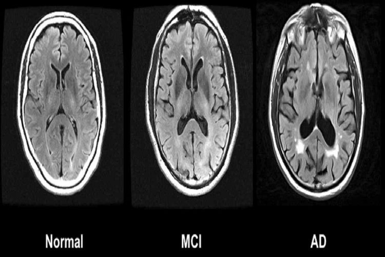 Il cervello di una persona che soffre di Alzheimer messo a confronto con uno normale