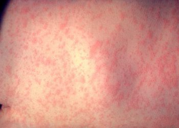Le tipiche macchie sulla pelle causate dal morbillo