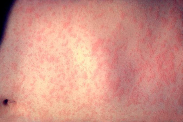 Le tipiche macchie sulla pelle causate dal morbillo