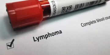 I dati sui linfomi in Italia
