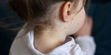 I dati sul morbillo nel 2024