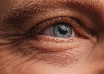 Patologia oculare tiroidea