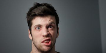 Un uomo con una paralisi del volto