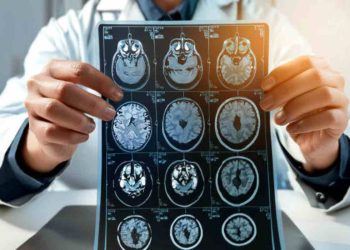 Diagnosi sclerosi multipla con l'IA