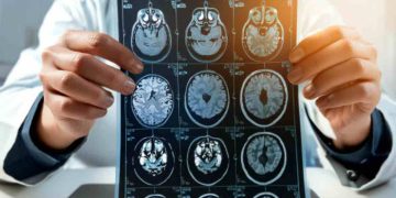 Diagnosi sclerosi multipla con l'IA