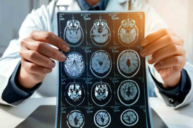 Diagnosi sclerosi multipla con l'IA