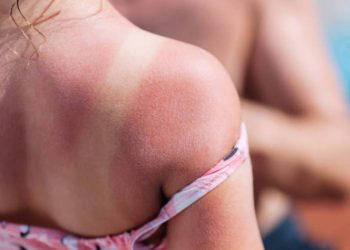 Le scottature aumentano il rischio di melanoma