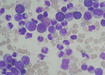 Chronic_Myeloid_Leukemia_smear_2009-04-09@commons.wikimedia.org