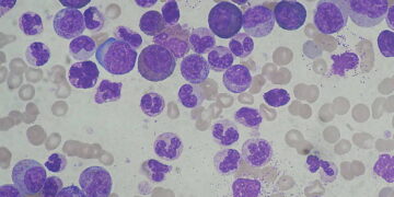Chronic_Myeloid_Leukemia_smear_2009-04-09@commons.wikimedia.org