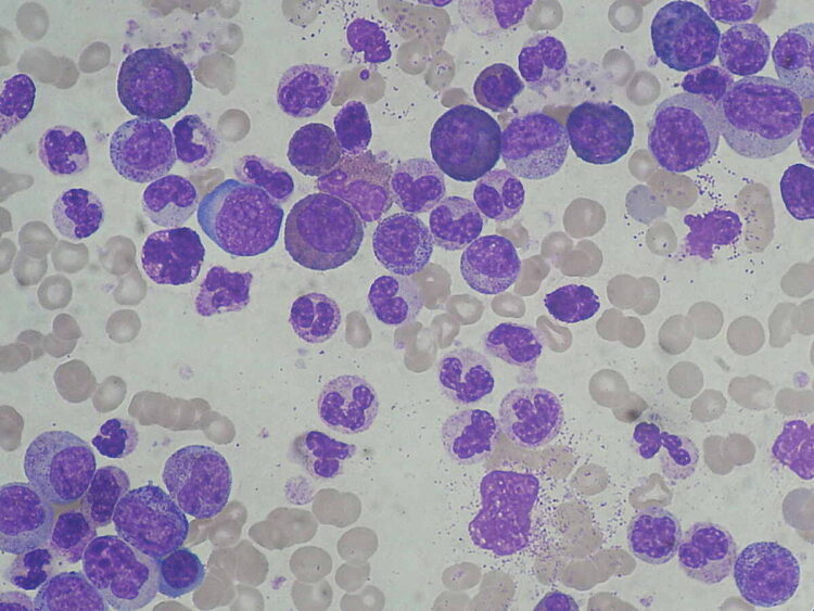 Chronic_Myeloid_Leukemia_smear_2009-04-09@commons.wikimedia.org