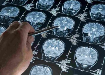 Tracciata la prima mappa del rischio genetico dell'Alzheimer