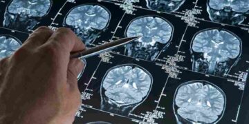 Tracciata la prima mappa del rischio genetico dell'Alzheimer
