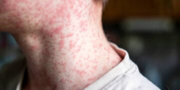 Il morbillo in Italia e nel mondo