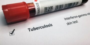 Segnalati 4 casi di tubercolosi nel trapanese