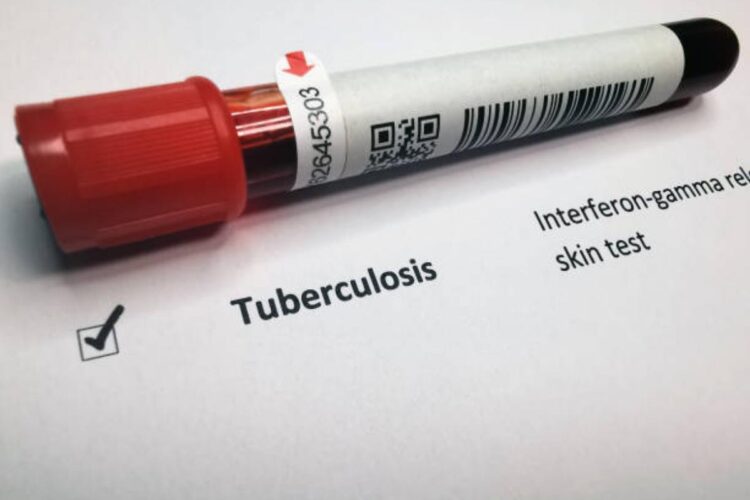 Segnalati 4 casi di tubercolosi nel trapanese