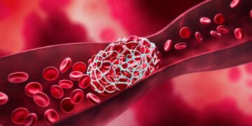 Soperto il meccanismo delle trombosi nel Covid