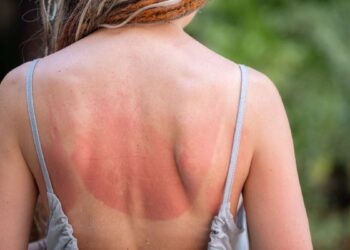 Una donna con la schiena scottata