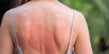 Una donna con la schiena scottata