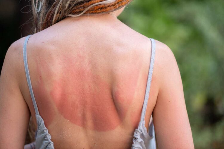 Una donna con la schiena scottata