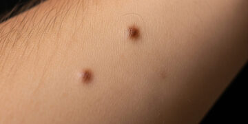 Un braccio con dei nei