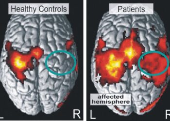 Le differenze tra un cervello sano e quello di una persona colpita da un ictus