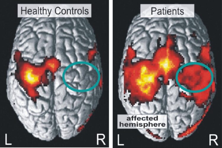 Le differenze tra un cervello sano e quello di una persona colpita da un ictus