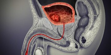 Una rappresentazione del tumore alla vescica