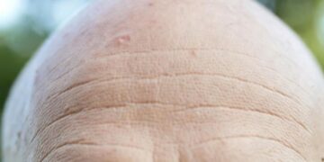 Cura per la calvizie