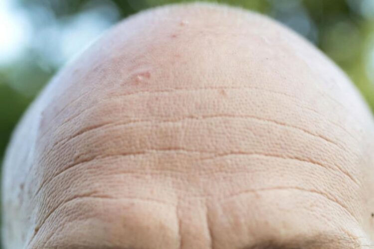 Cura per la calvizie