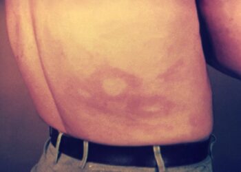 Macchie sulla pelle causate dalla lebbra