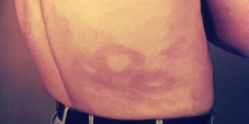 Macchie sulla pelle causate dalla lebbra