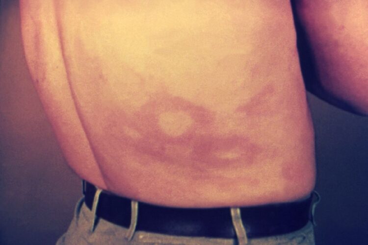 Macchie sulla pelle causate dalla lebbra