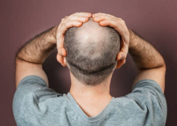Svolta nella lotta alla calvizie