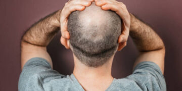 Svolta nella lotta alla calvizie