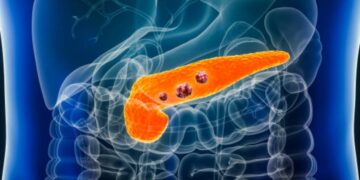 Possibile cura per il tumore al pancreas