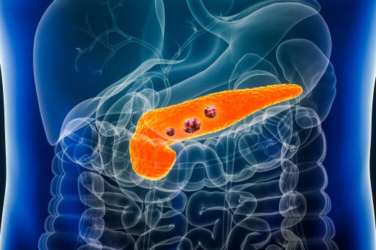 Possibile cura per il tumore al pancreas