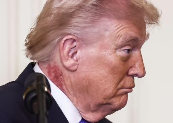 Trump e il collo arrossato