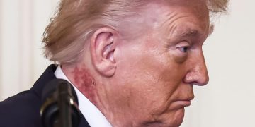 Trump e il collo arrossato