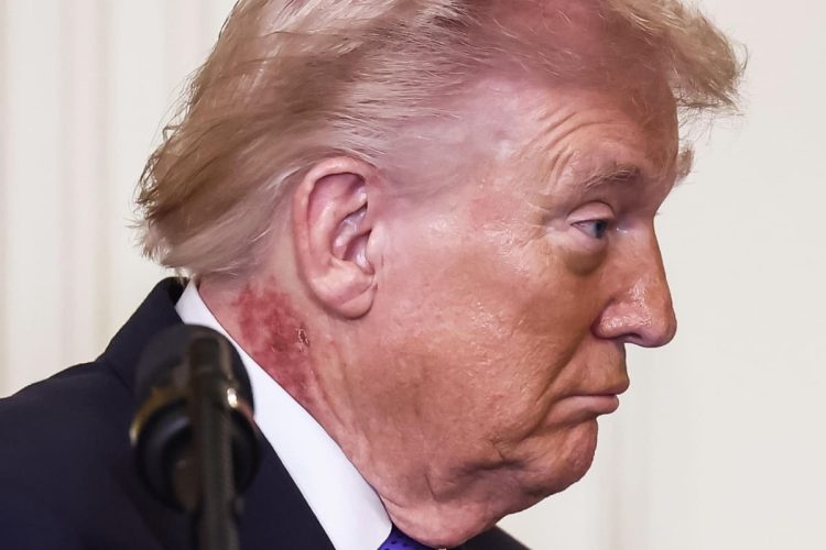 Trump e il collo arrossato