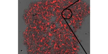 Tumore alla mammella