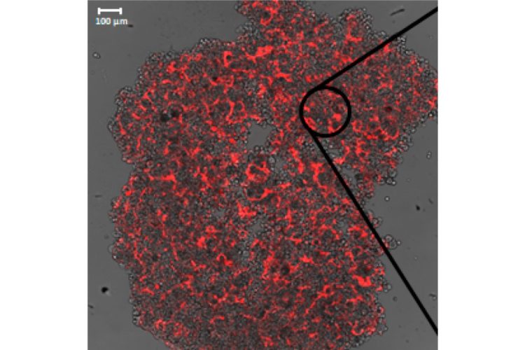 Tumore alla mammella