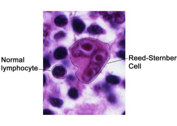 Immagine al microscopio di una cellula di Reed-Sternberg, caratteristica del linfoma di Hodgkin, confrontata con un normale linfocita in un campione di tessuto linfatico