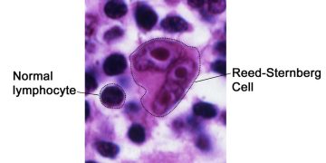 Immagine al microscopio di una cellula di Reed-Sternberg, caratteristica del linfoma di Hodgkin, confrontata con un normale linfocita in un campione di tessuto linfatico