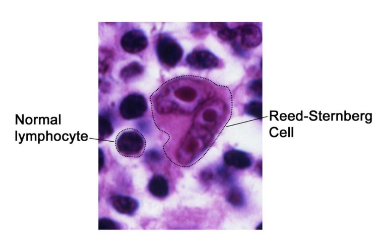 Immagine al microscopio di una cellula di Reed-Sternberg, caratteristica del linfoma di Hodgkin, confrontata con un normale linfocita in un campione di tessuto linfatico