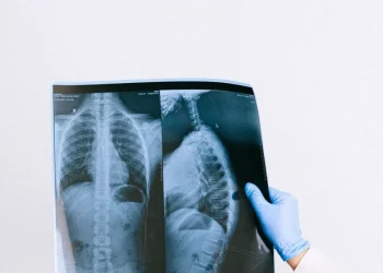 Mano con guanto medico esamina radiografia torace e colonna vertebrale di una persona affetta da tumore al polmone