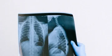 Mano con guanto medico esamina radiografia torace e colonna vertebrale di una persona affetta da tumore al polmone