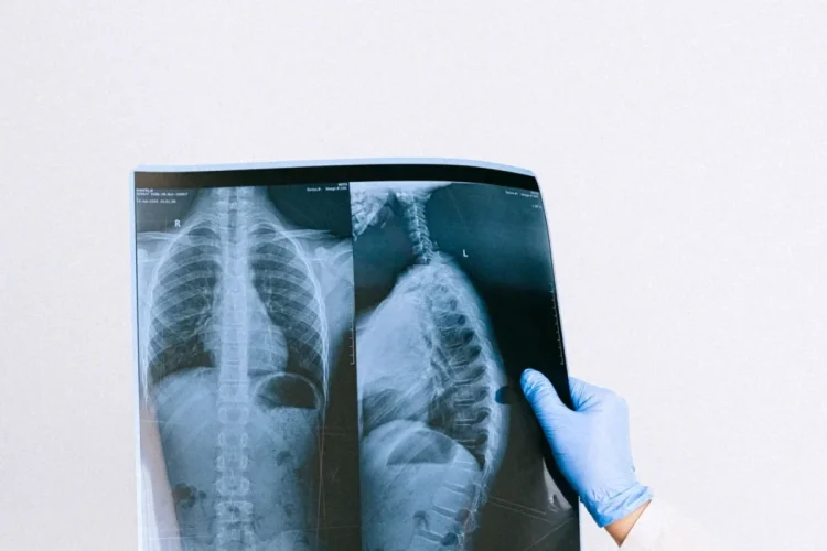 Mano con guanto medico esamina radiografia torace e colonna vertebrale di una persona affetta da tumore al polmone