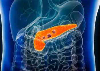 Tumore del pancreas, un nuovo farmaco riaccende la speranza